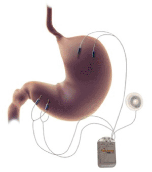 Image: The Diamond attached via electrodes to the stomach muscles (Photo courtesy of Metacure).